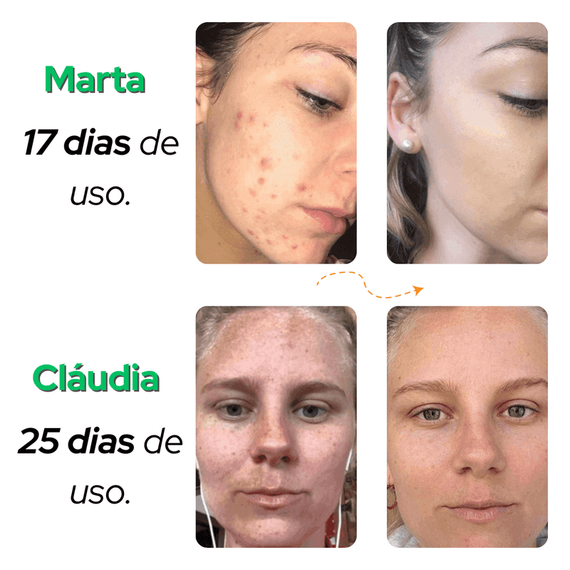 Sérum ESSENCE - XÔ MELASMA E MANCHAS - RESULTADOS NO PRIMEIRO USO + BRINDE EXCLUSIVO - Minha loja